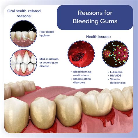 How To Treat Bleeding Gums