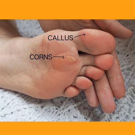 How To Treat Calluses Feet