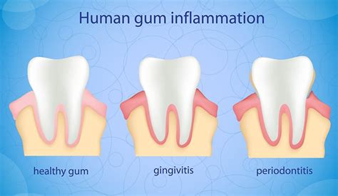 How To Treat Inflamed Gums