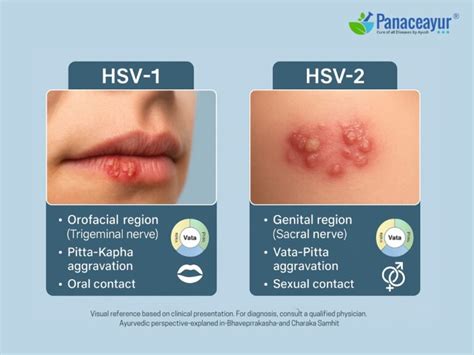 Hsv 2 Cure