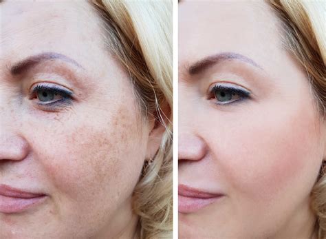 Hyperpigmentation Laser Treatment