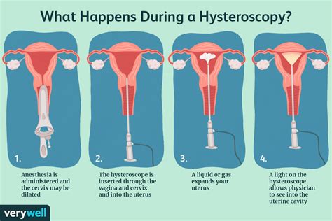 Hysteroscopy With Dilation And Curettage