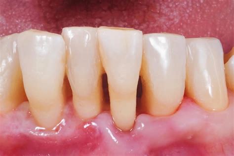 I Healed My Receding Gums