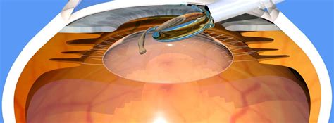 Implantable Contact Lenses