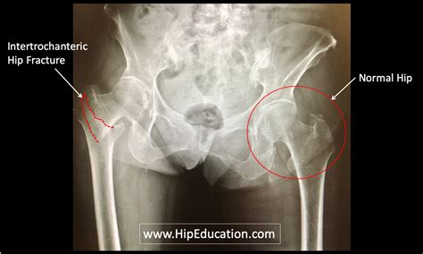 Intertrochanteric Hip Fracture