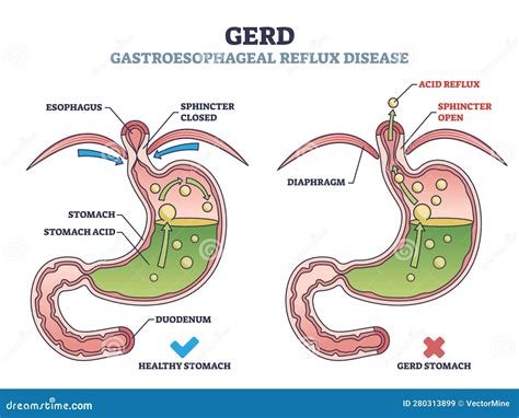 Is Acid Reflux Disease Hereditary