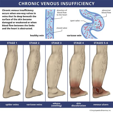 Is Chronic Venous Insufficiency Fatal