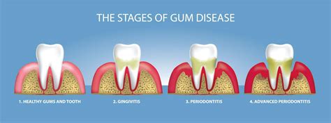Is Gum Disease Contagious