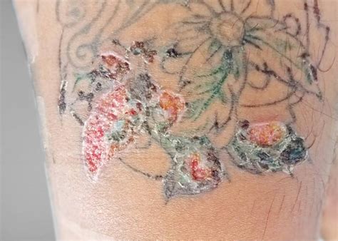 Is It Bad To Itch A Tattoo