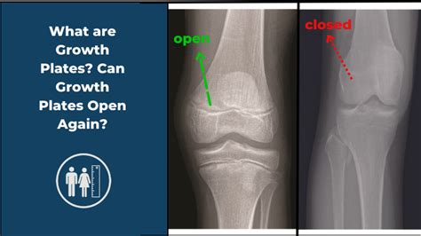 Is It Possible To Reopen Growth Plates