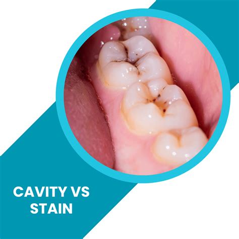 Is It Stain Or Cavity