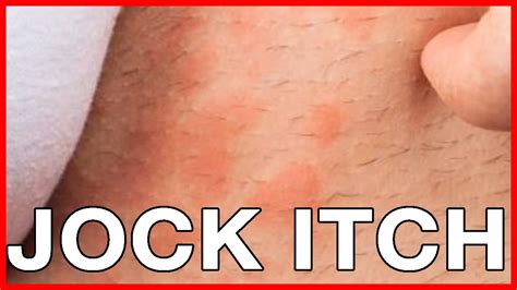 Is Jock Itch Communicable