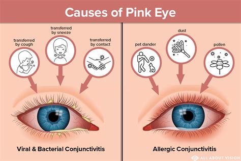 Is Pink Eye Itchy