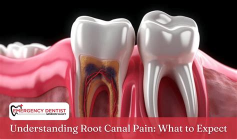 Is Root Canal Painful