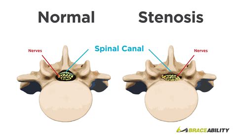 Is Spinal Stenosis Hereditary