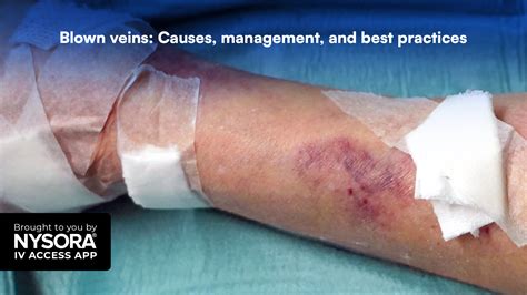 Iv Vein Blown