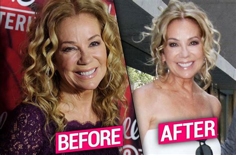 Kathie Lee Gifford Face Surgery