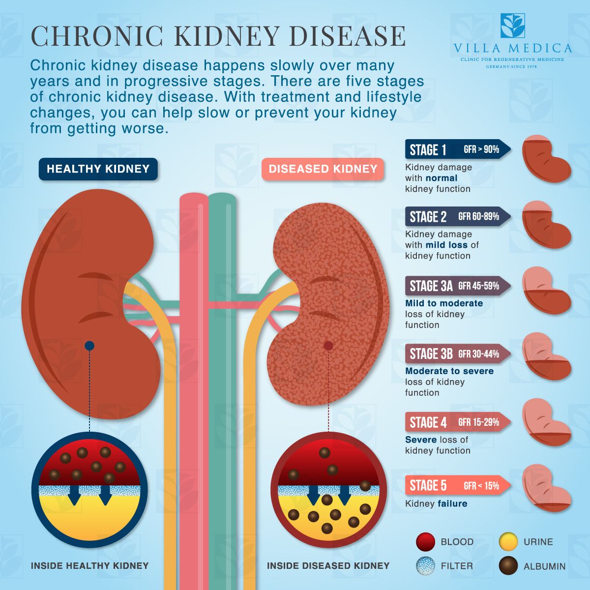 Kidney Stones And Calcium Oxalate