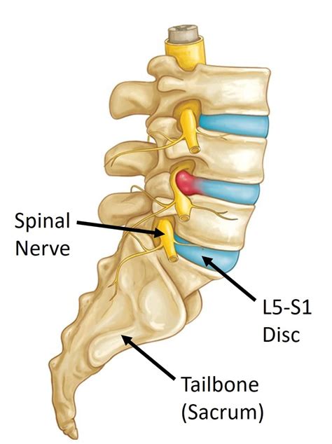 L5s1 Degenerative Disc Disease