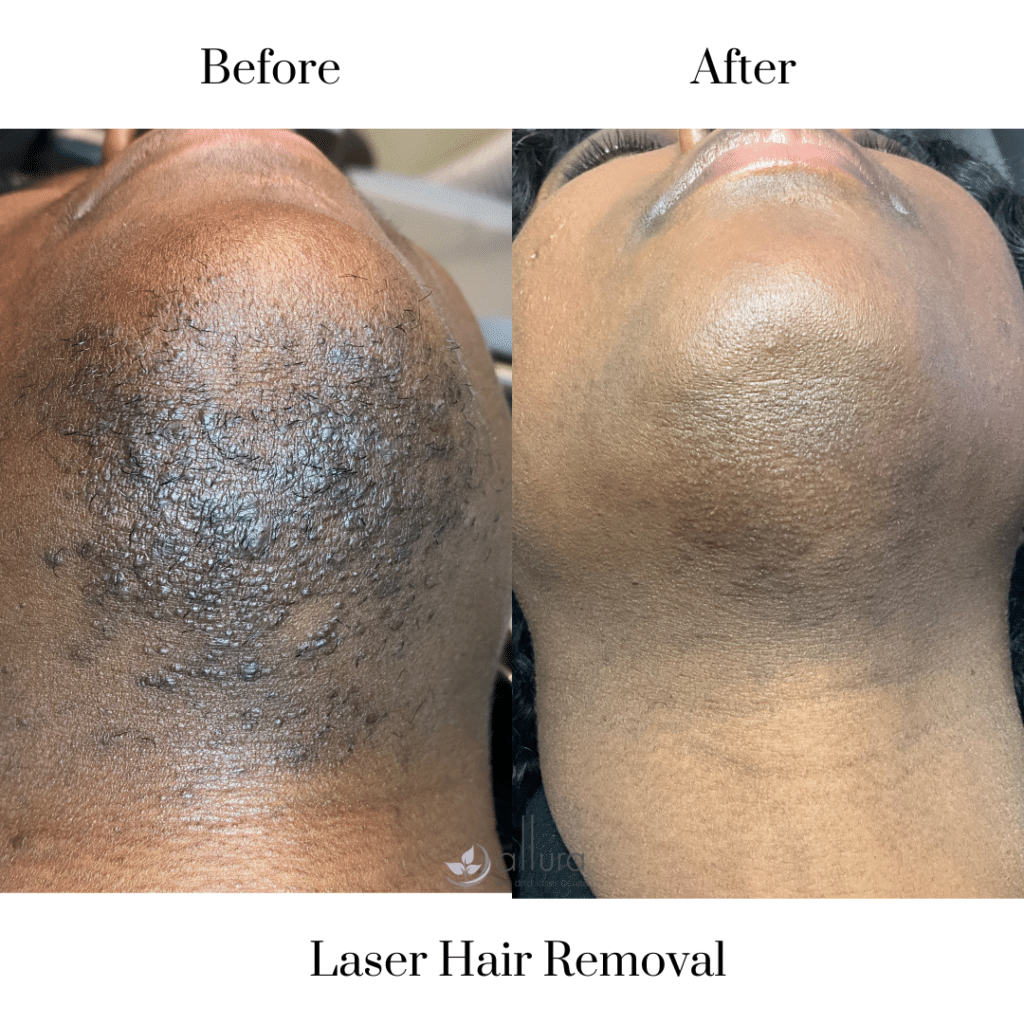 Laser Procedure For Acne