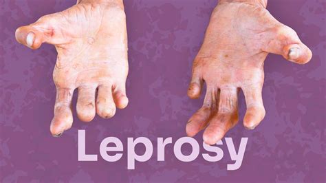 Leprosy Does It Still Exist