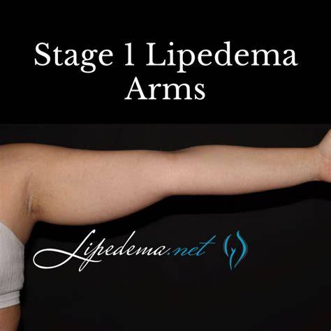 Lipedema In Arms