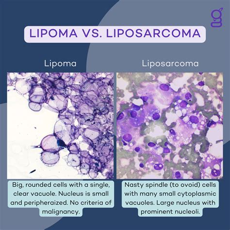 Lipoma Vs Liposarcoma