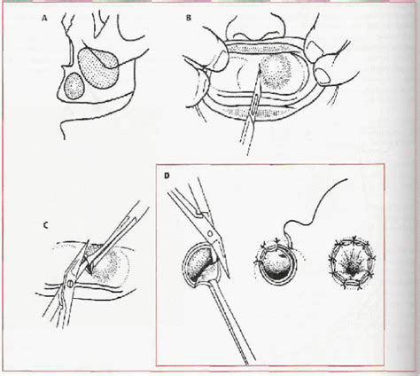 Marsupialized Bartholin Cyst