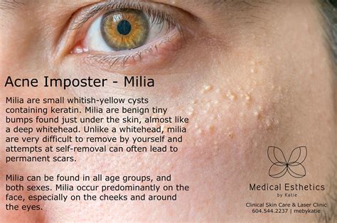 Milia What Causes