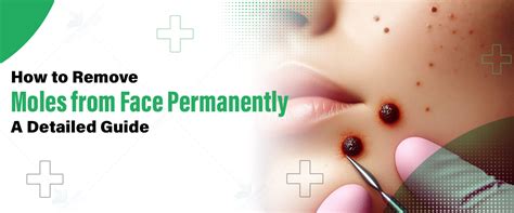 Mole Removal At Home