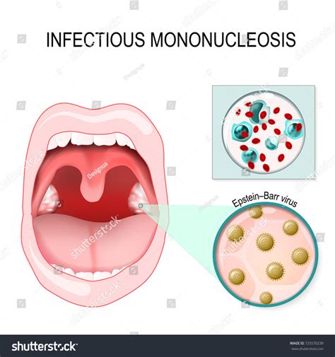 Mononucleosis Mouth Ulcers