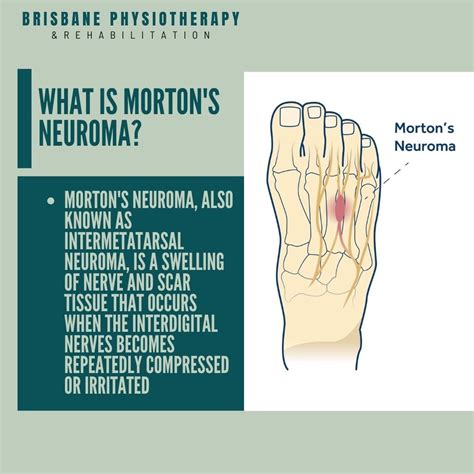 Morton's Neuroma Symptoms