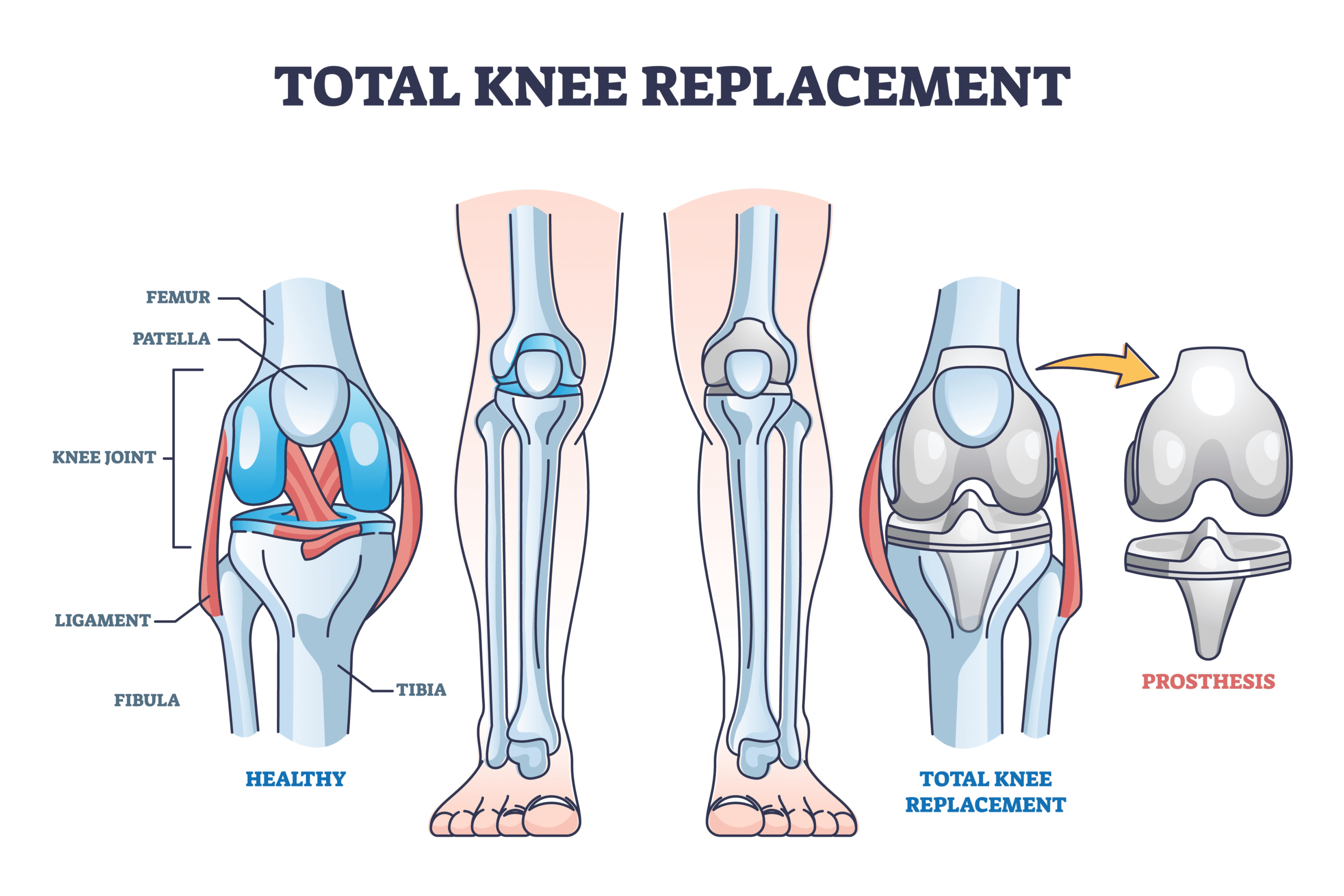 Understanding The Real Negative Effects Of Knee Replacement Surgery