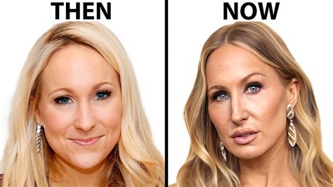 Nikki Glaser Before And After Face Surgery