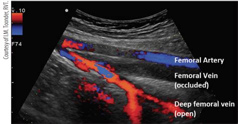 Noncompressible Dvt Ultrasound Color Doppler