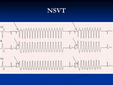 Nsvt Medical Abbreviation