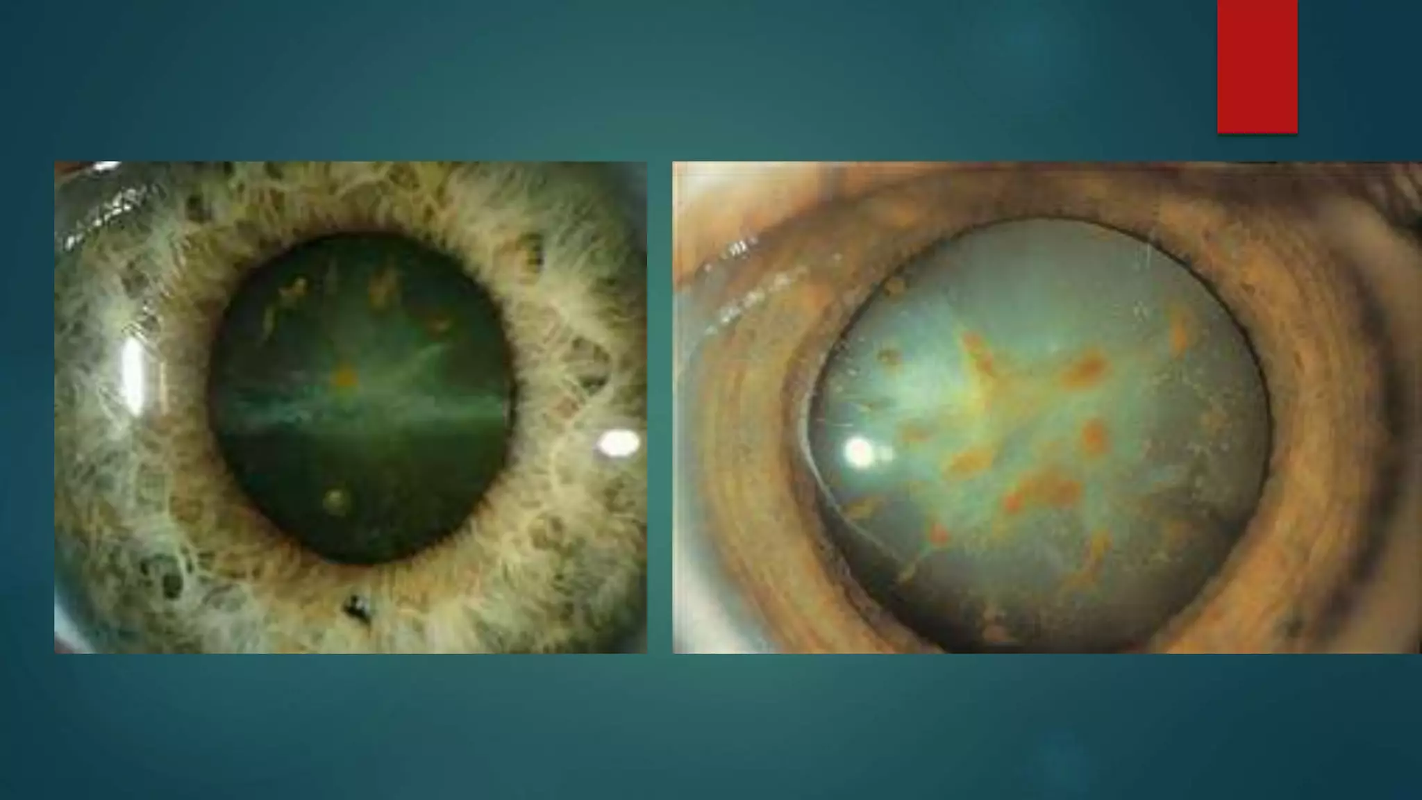 Ocular Micrometer