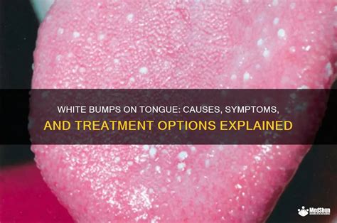 On Tongue White Bumps