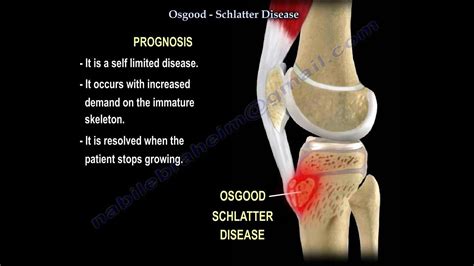 Osgood Syndrome Knee