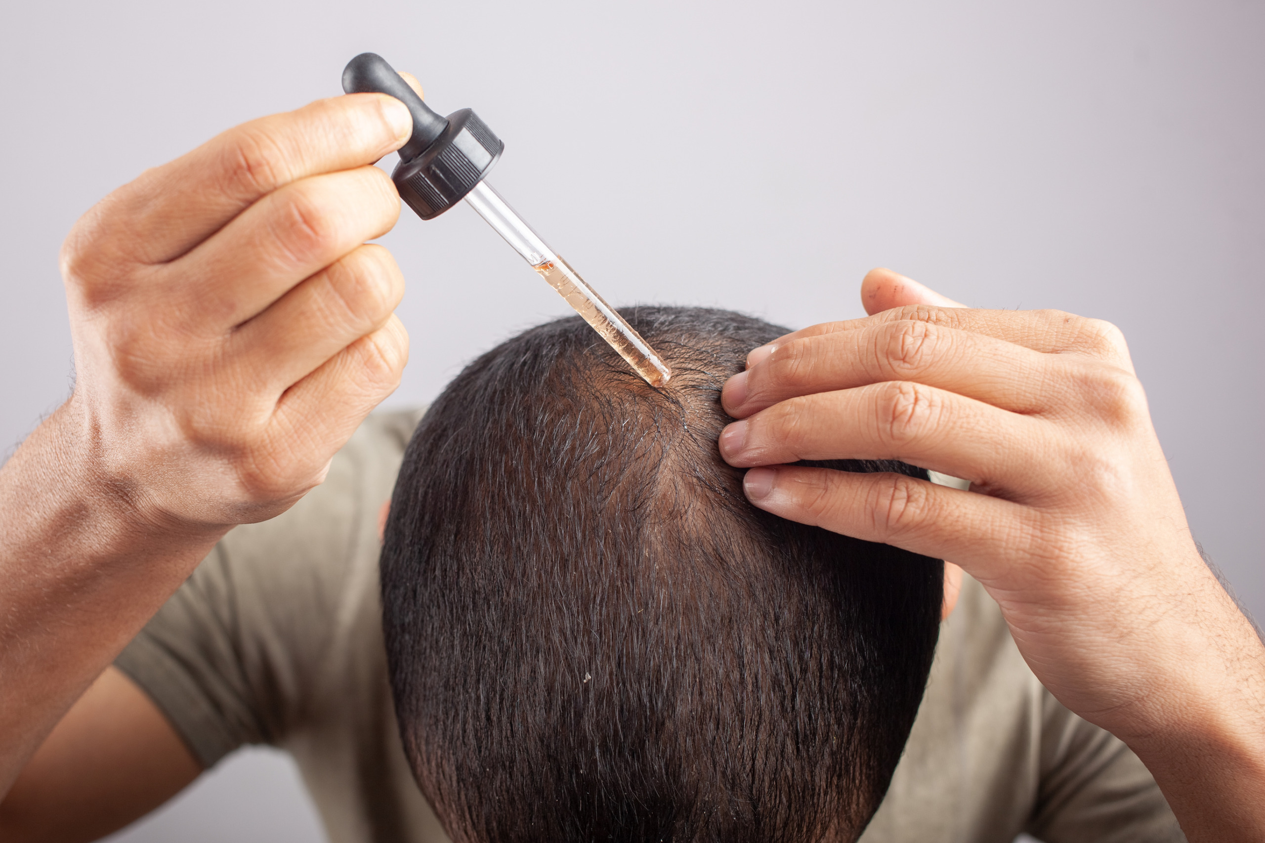 Beyond Scalps: Surprising Other Uses Of Minoxidil Explained