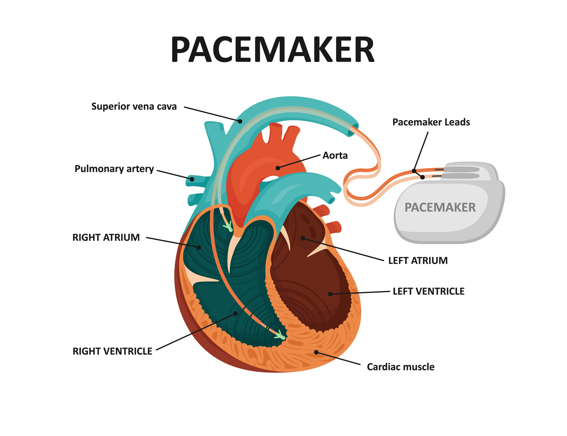Pacemaker Battery Replacement