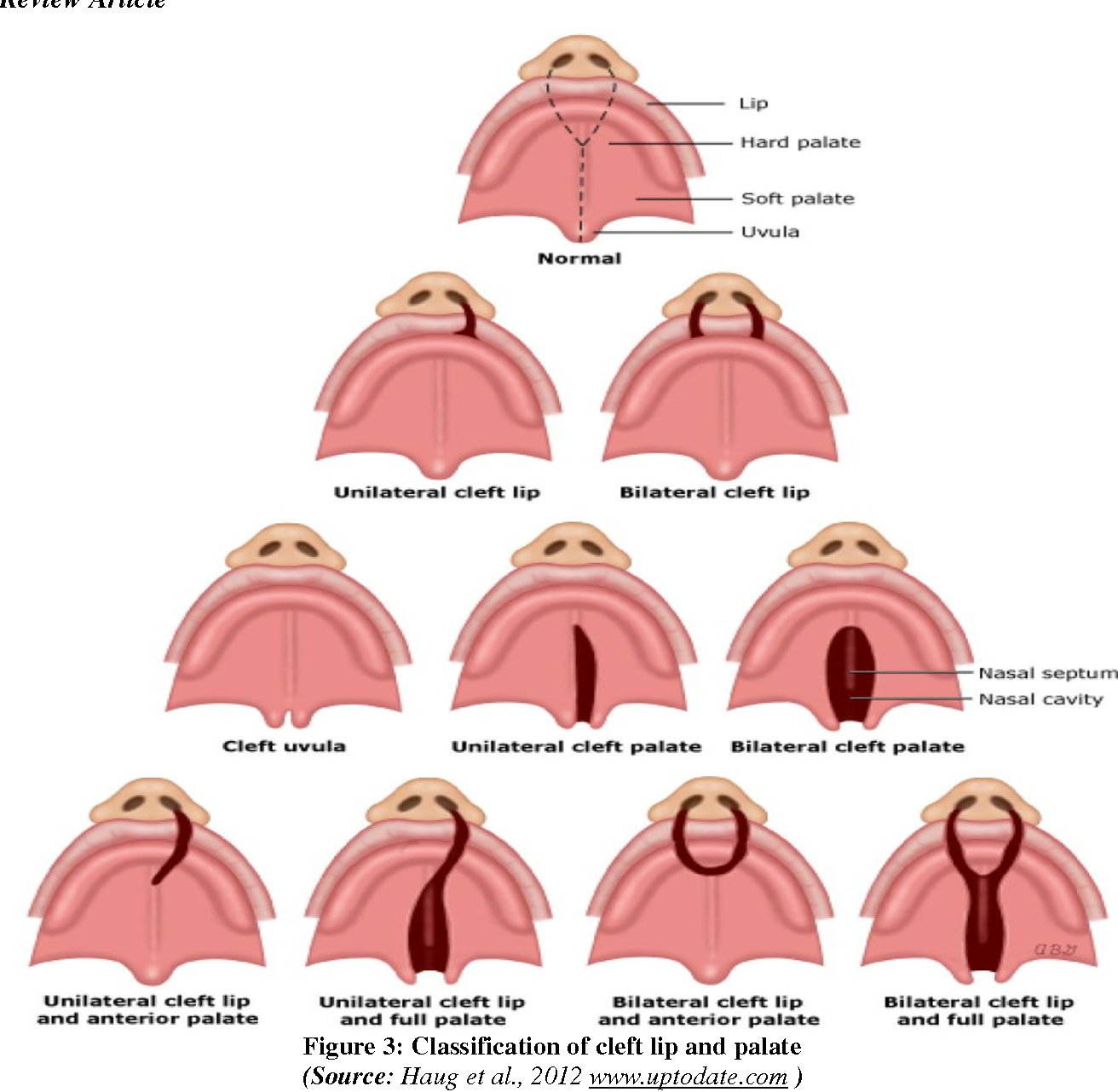 Palate Expander Kids