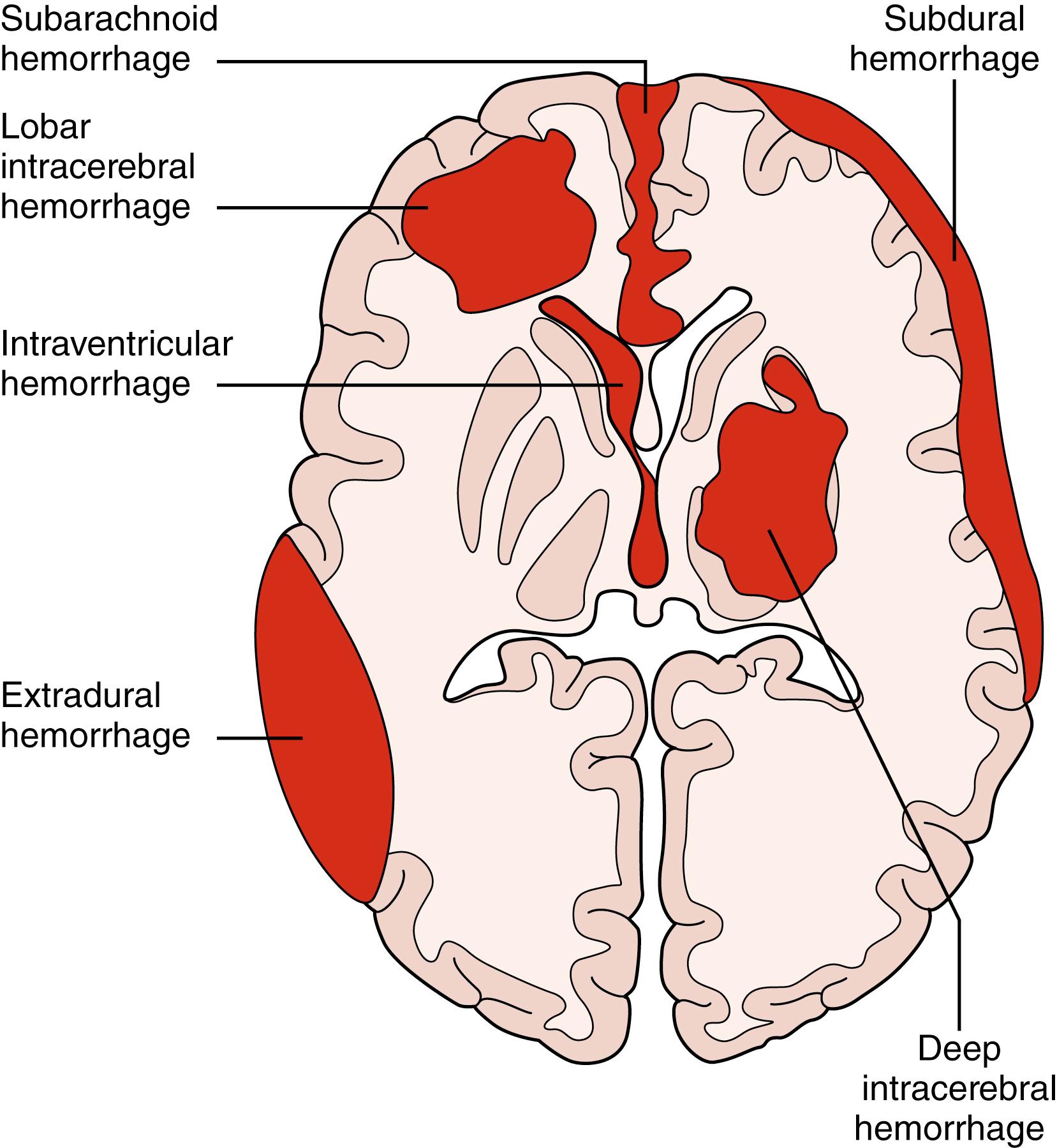 Parenchymal Volume Loss