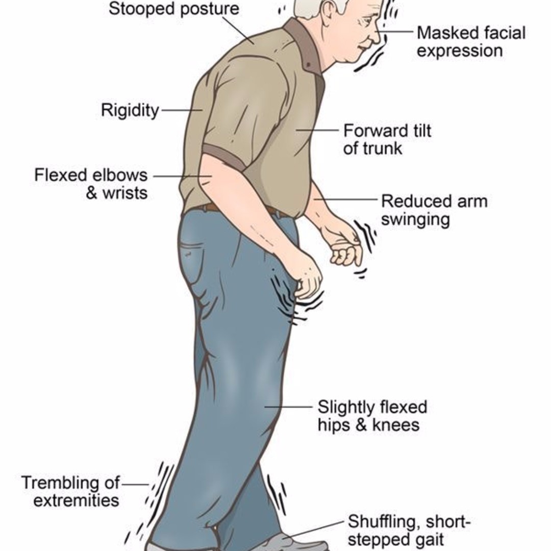 Parkinson's Life Expectancy