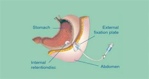 Percutaneous Endoscopic Gastrostomy