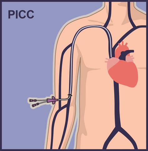Picc Line Placement