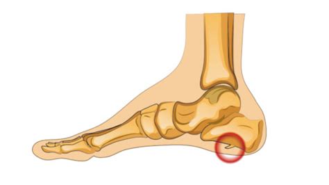 Pictures Of Bone Spurs