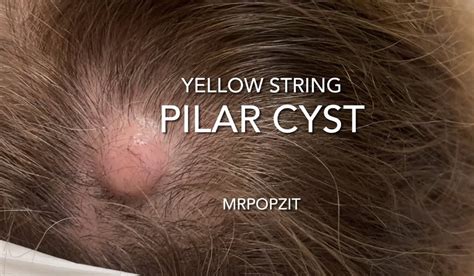 Pilar Cyst On Scalp