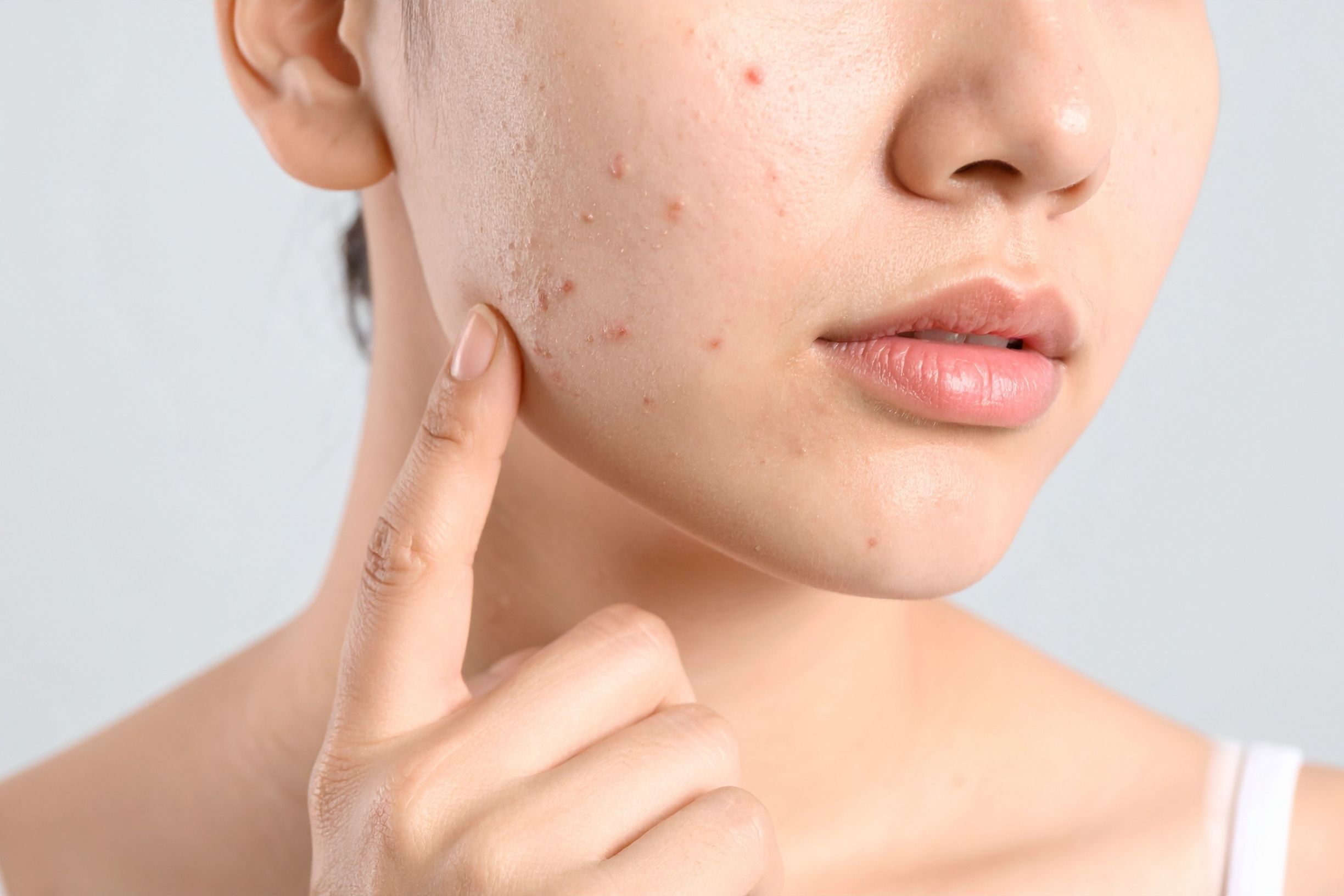 Pimples On Chest