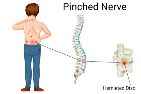 Pinched Nerve In Hip Symptoms